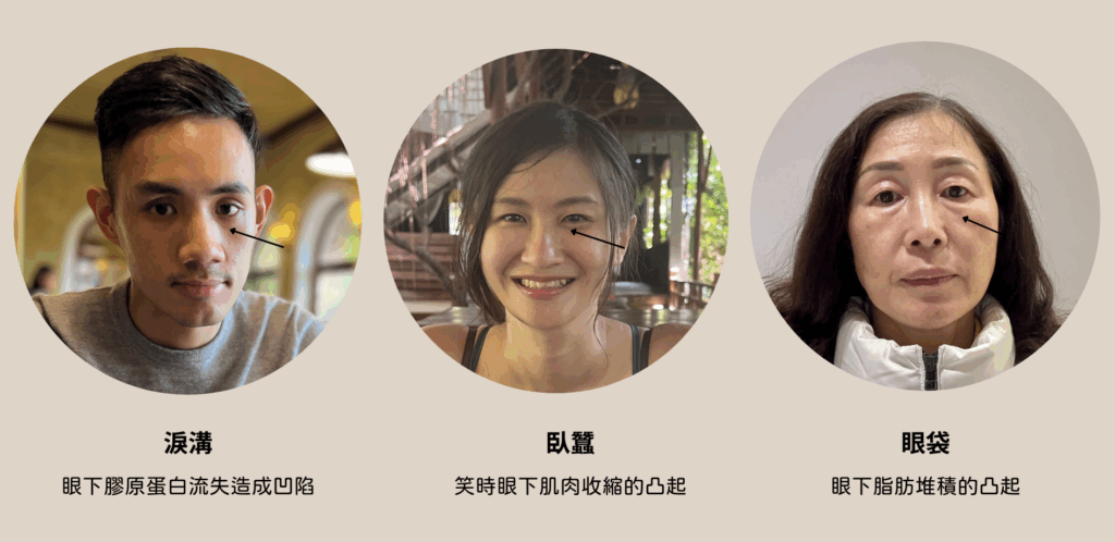 淚溝 臥蠶 眼袋差別
